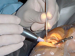 250px-Cataract_surgery